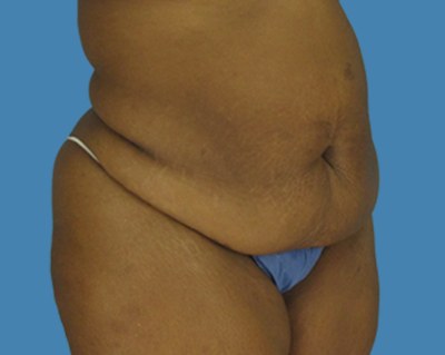 Before Image: LipoTuck, Tummy Tuck, Plus-Size Tummy Tuck - front