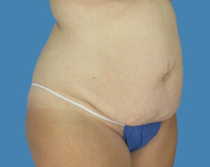Before Image: LipoTuck, Tummy Tuck