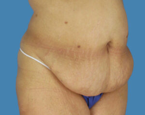 Before Image: LipoTuck, Tummy Tuck, Plus-Size Tummy Tuck