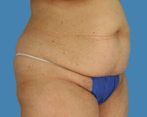 Before Image: LipoTuck, Tummy Tuck, Plus-Size Tummy Tuck