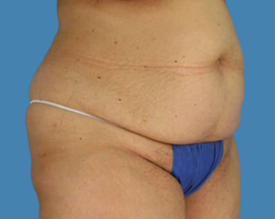 Before Image: LipoTuck, Tummy Tuck, Plus-Size Tummy Tuck - front