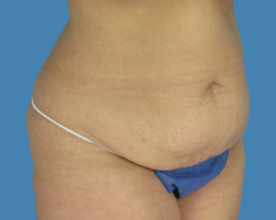 Before Image: LipoTuck, Tummy Tuck - front