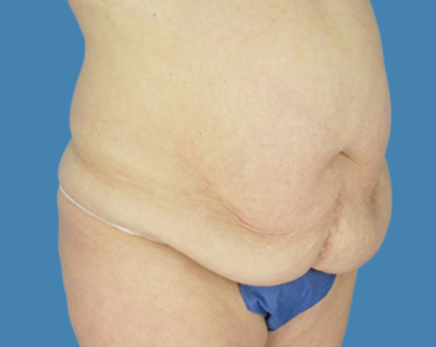 Before Image: LipoTuck, Tummy Tuck, Plus-Size Tummy Tuck - front