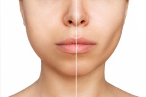 A cropped comparison of a young woman's face shows the before and after results of buccal fat pad removal, revealing more defined cheekbones post-surgery