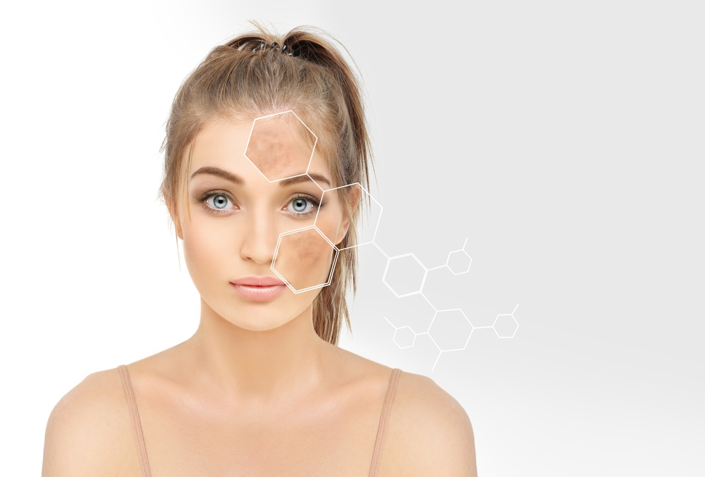 Skin with dark spots, freckles, and hyperpigmentation treated using AHA chemical peel for brightening and lightening.