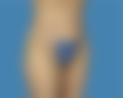 After LipoTuck™ Sugar Land TX
