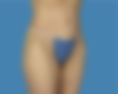 After LipoTuck™ Sugar Land TX