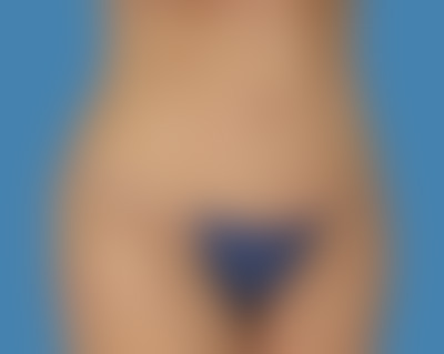 After LipoTuck™ Houston TX