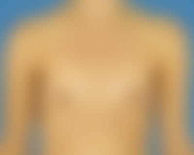 Before Breast Augmentation Houston TX