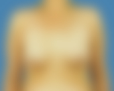 Before Breast Augmentation Sugar Land TX