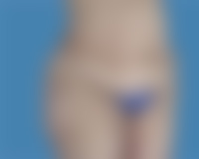 Before Body Contouring Sugar Land TX