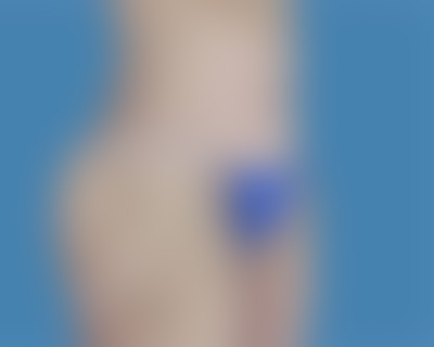 After Body Contouring Sugar Land TX