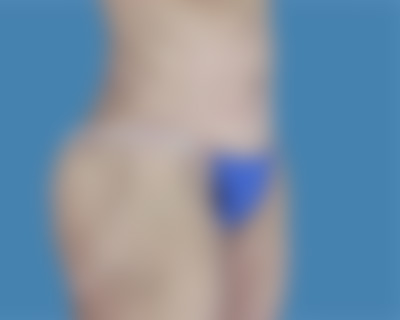 After Body Contouring Sugar Land TX