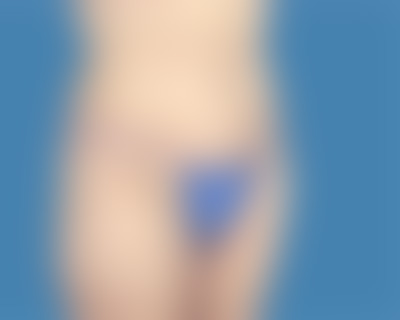 After Body Lift Treatment Houston TX