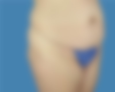 Before LipoTuck™ Treatment Houston TX