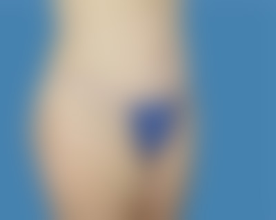 After LipoTuck™ Treatment Houston TX