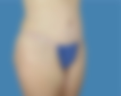 After LipoTuck™ Treatment Houston TX