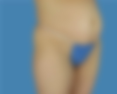 Before LipoTuck™ Sugar Land TX