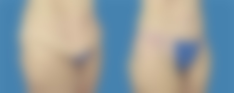 1740677774 body lipotuck p35 1.jpg