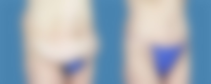 1740677778 body lipotuck p26 1.jpg