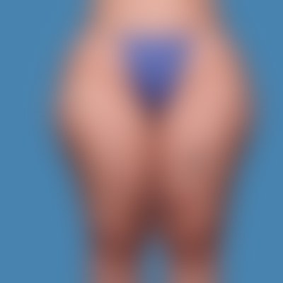 Before Thigh Lift Treatment Houston