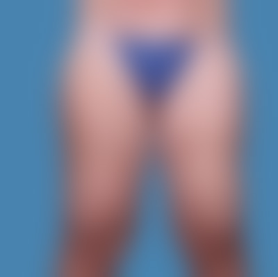 Before Thigh Lift Sugar land TX