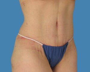 After Image: LipoTuck, Tummy Tuck