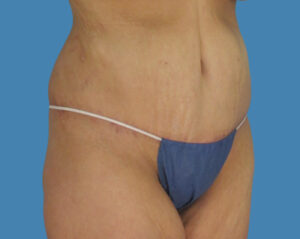 After Image: LipoTuck, Tummy Tuck, Plus-Size Tummy Tuck, After Weight Loss Tummy Tuck