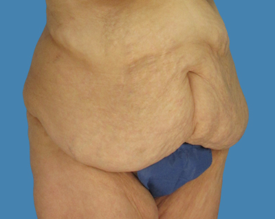 Before Image: LipoTuck, Tummy Tuck, Plus-Size Tummy Tuck, After Weight Loss Tummy Tuck - front