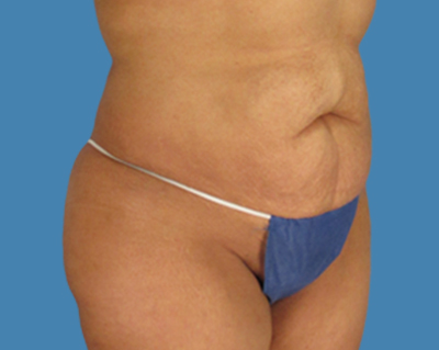 Before Image: LipoTuck, Tummy Tuck - front