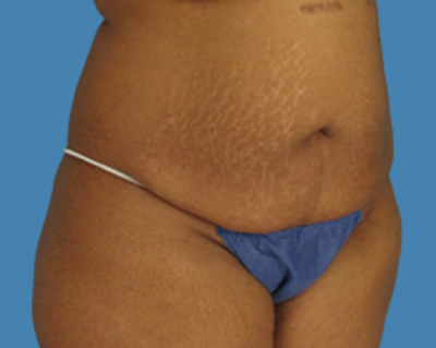Before Image: LipoTuck, Tummy Tuck - front