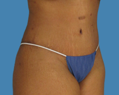 After Image: LipoTuck, Tummy Tuck - front
