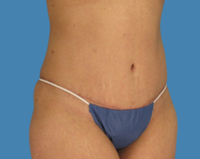 After Image: LipoTuck, Tummy Tuck - front