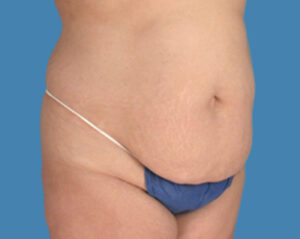 Before Image: LipoTuck, Tummy Tuck