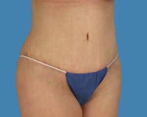 After Image: LipoTuck, Tummy Tuck