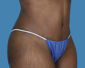 After Image: LipoTuck, Tummy Tuck