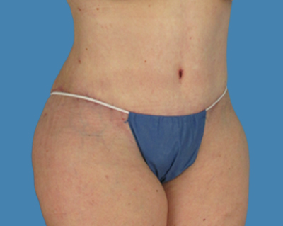 After Image: LipoTuck, Tummy Tuck, Plus-Size Tummy Tuck - front