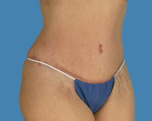 After Image: LipoTuck, Tummy Tuck, Plus-Size Tummy Tuck