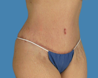 After Image: LipoTuck, Tummy Tuck, Plus-Size Tummy Tuck - front