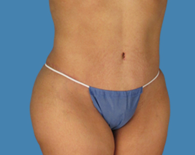 After Image: LipoTuck, Tummy Tuck - front