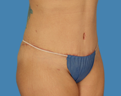 After Image: LipoTuck, Tummy Tuck, Plus-Size Tummy Tuck - front