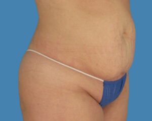 Before Image: LipoTuck, Tummy Tuck