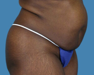 Before Image: LipoTuck, Tummy Tuck