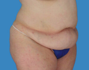 Before Image: LipoTuck, Tummy Tuck, Plus-Size Tummy Tuck