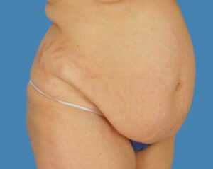 Before Image: LipoTuck, Tummy Tuck, Plus-Size Tummy Tuck