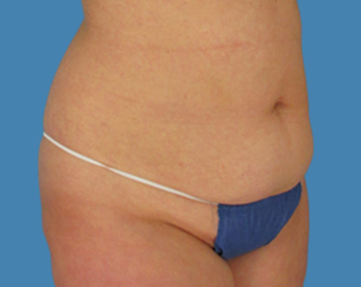 Before Image: LipoTuck, Tummy Tuck - front