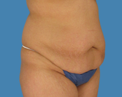 Before Image: LipoTuck, Tummy Tuck - front