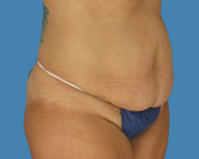 Before Image: LipoTuck, Tummy Tuck, Plus-Size Tummy Tuck - front