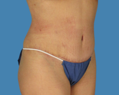 After Image: LipoTuck, Tummy Tuck - front