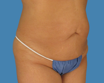 Before Image: LipoTuck, Tummy Tuck - front